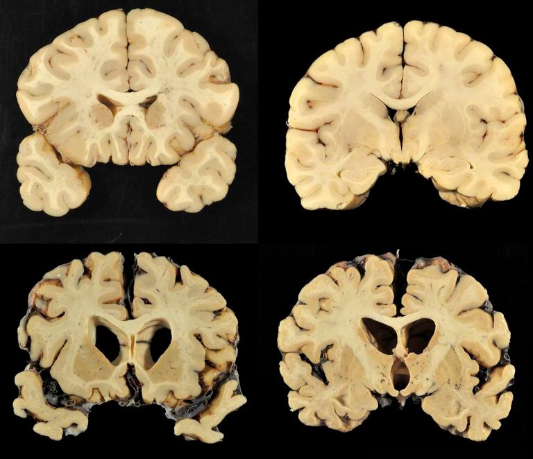 Esta combinación de fotos proporcionadas por la Universidad de Boston muestra secciones de un cerebro normal, arriba, y del cerebro del ex jugador de fútbol americano de la Universidad de Texas Greg Ploetz, abajo, en la etapa IV de encefalopatía traumática crónica. 