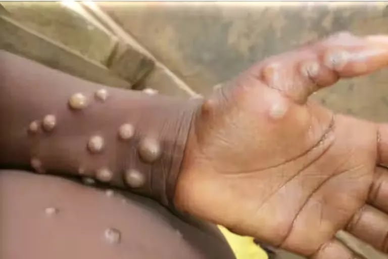 “Biggest monkeypox outbreak ever seen in Europe”: warning from health authorities