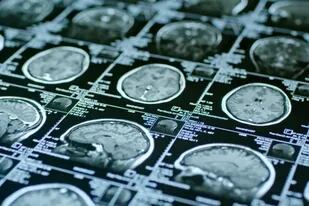 Origen, tipos y tratamientos de tumores cerebrales
