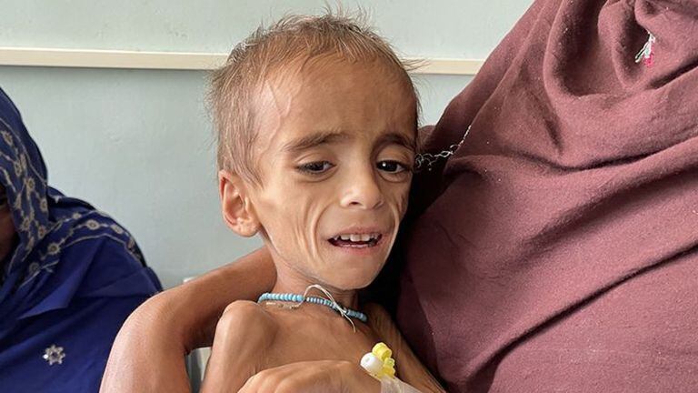 Un niño con desnutrición en Kandahar, en Octubre