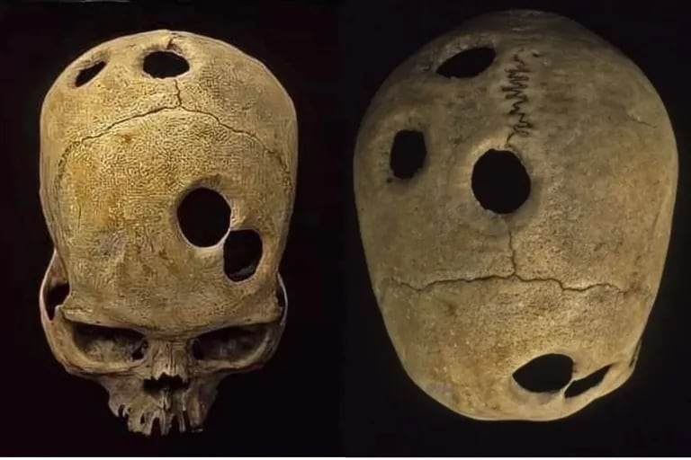 A skull with a perfect hole confirms that the Incas successfully performed complex surgeries