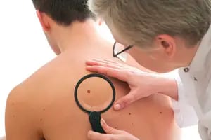 Lo que debés saber sobre el tipo más común de cáncer de piel