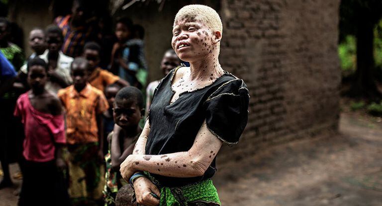 La tasa de natalidad de personas con albinismo en África Oriental es aproximadamente una de cada 1400