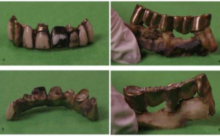 Las piezas dentarias de Adolf Hitler fueron analizadas más de una vez por diferentes expertos, y siempre coincidieron en que, efectivamente, pertenecían al monstruoso líder nazi