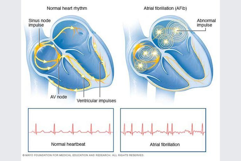 Infografía sobre un corazón con un ritmo cardíaco normal (izquierda) y otro con arritmia.