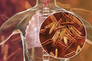 Por qué las restricciones por el Covid-19 provocan medio millón de muertes adicionales por tuberculosis