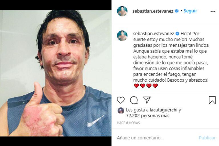 Sebastián Estevanez mostró cómo le quedó el rostro tras el accidente doméstico