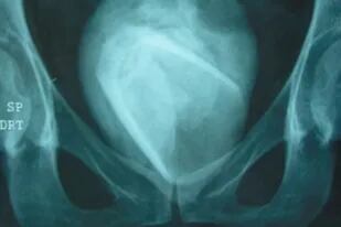 Los médicos descubrieron el objeto luego de hacerle una radiografía a la paciente