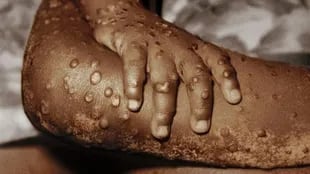 Symptoms of monkeypox include rash, fever, headache, muscle aches, backache, swollen lymph nodes, chills, and fatigue.