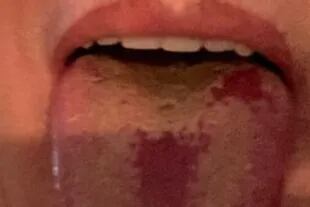Lesiones en la lengua por Covid