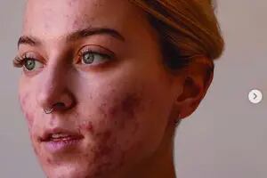 Acné, vitiligo y cicatrices: quiénes son las influencers que muestran su piel al natural
