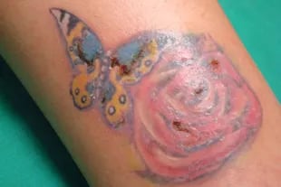 Tatuaje en la pierna de una joven con dermatitis por contacto a sales de cromo utilizadas en los pigmentos para tatuajes de color azul