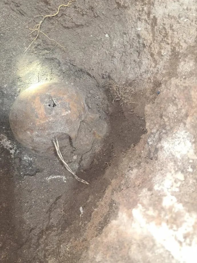 Aspecto del agujero en el cráneo encontrado en Argentina. 