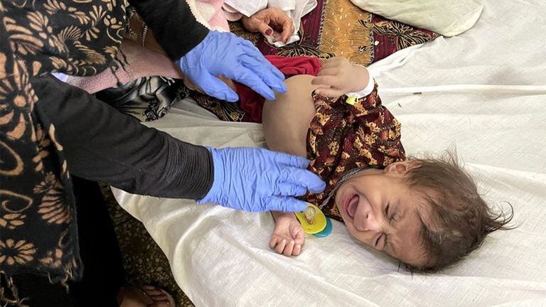 Un niño recibe tratamiento médico en el hospital Mir Veys, en Kandahar, Afganistán, el 28 de octubre del 2021