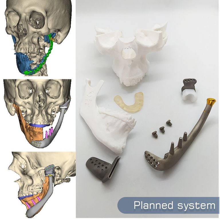 Una empresa cordobesa exporta prótesis óseas a medida impresos en 3 D