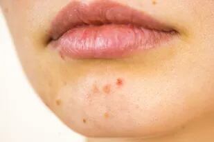 Todo lo que tenés que saber sobre esta infección en la piel y cómo prevenirla