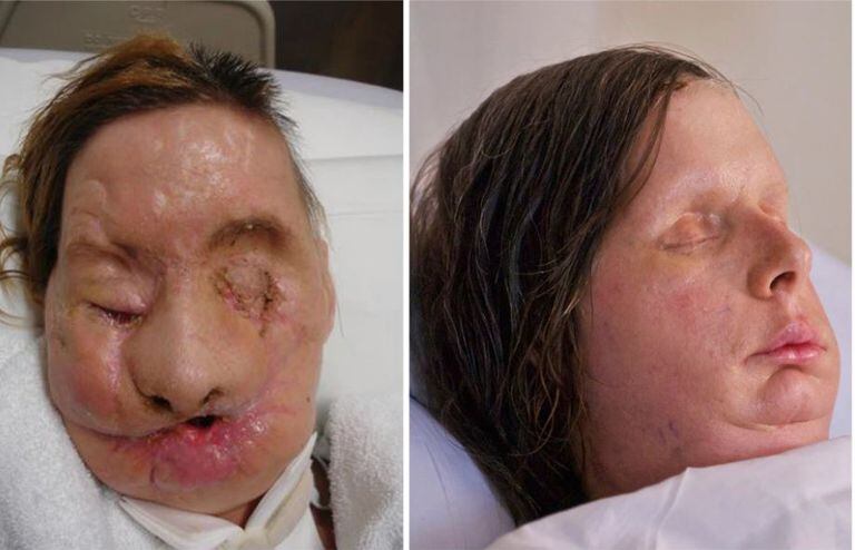 Nash underwent various face transplant operations