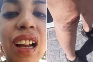 Abril subió a las redes sociales las heridas que le causó el codazo del policía y las heridas recibidas por su amiga al ser arrastrada