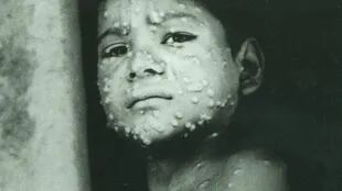 La viruela es un caso raro de una enfermedad viral que logró erradicarse, aunque en años recientes han ocurrido algunos brotes.