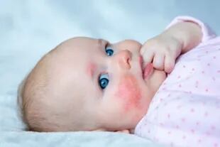 Los recién nacidos, que tienen conductos sudoríparos menos desarrollados que pueden obstruirse fácilmente y más rollos de piel, son más susceptibles al sarpullido que los niños mayores y los adultos