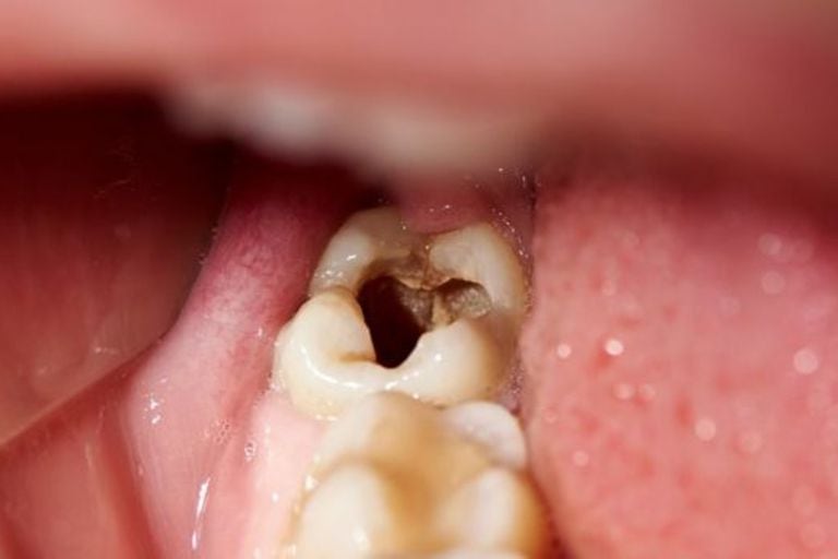 Algunas bacterias de la microbiota oral aumentan su presencia y otras la reducen en caries y enfermedades periodontales, como la gingivitis y la periodontitis