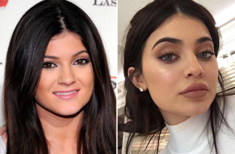 Cuando tenía quince años, Kylie Jenner se rellenó los labios y luego se arrepintió