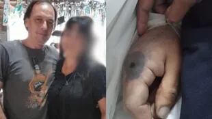 El hombre de 52 años que murió en La Plata por la mordedura de la arña del rincón