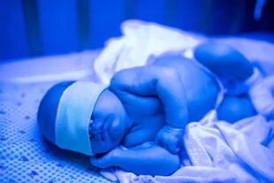 La ictericia es común en los recién nacidos, y se trata con fototerapia para descomponer el exceso de bilirrubina