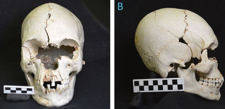 Frontal y lateral del cráneo con evidencia de lepra descubierto en el Caribe