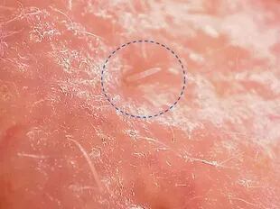 El ácaro Demodex folliculorum en la piel bajo el microscopio Hirox.