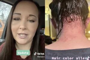 Se tiñó el cabello sin saber que era alérgica y el resultado fue devastador