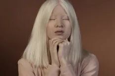 La bebé albina abandonada en China que se convirtió en modelo de Vogue