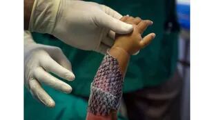 Doctores envuelven el brazo quemado de un niño con piel de tilapia