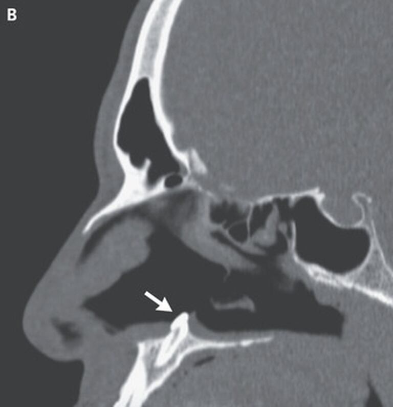 Una imagen tomada con rayos X mostró el diente ectópico que le había crecido en la nariz al paciente