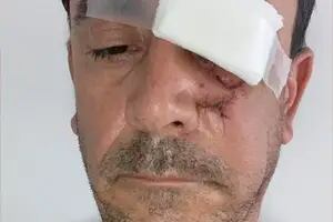 Le dijo que "no" a un limpiavidrios y recibió una grave agresión: le quebró un pómulo y casi pierde el ojo