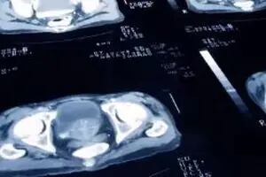Un estudio revela que el cáncer de próstata se puede curar con menos sesiones de radioterapia
