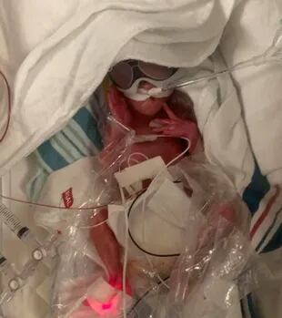 El primer bebé en nacer tenía solo un nueve porciento de probabilidades de sobrevivir. Fuente: Caters News Agency
