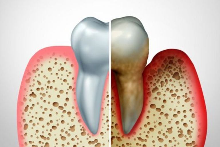 A la izquierda un diente normal, a la derecha uno cubierto de placa que ha provocado inflamación en las encías