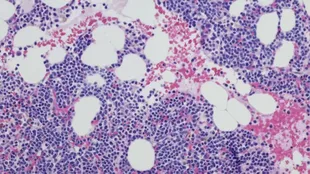 Il mieloma multiplo attacca le plasmacellule, un tipo di globuli bianchi che ha la funzione di produrre anticorpi per combattere le infezioni