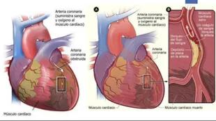 La mayoría de las personas con insuficiencia cardíaca tienen limitaciones para respirar