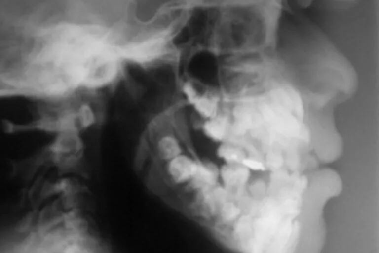 Las tomografías computadas permitieron hacer el conteo de las 81 piezas dentarias que posee una niña de 11 años