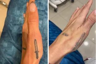 Antes y después, la primera de las sesiones de remoción de tatuajes para Micaela Tinelli.