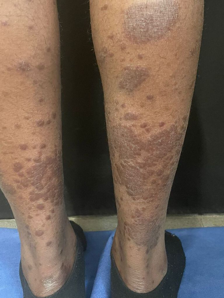La aparición de manchas en la piel, como urticaria o ronchas, son una señal de alerta para sospechar de la lepra