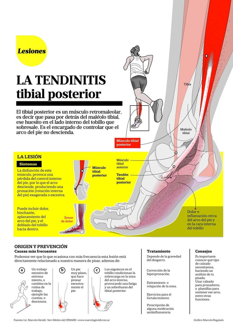 Tendinitis Tibial Posterior La Nacion 7027