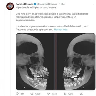 El caso de la niña de 11 años que cuenta con 81 dientes fue difundido esta semana por la cuenta de Twitter de divulgación científica Somos Cosmos