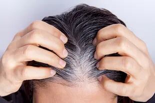 Una de las hipótesis que sostienen los especialistas es que se trata de un tipo inusual de alopecia areata, una enfermedad autoinmune en la cual existe un ataque a los folículos pilosos con la consiguiente pérdida, generalmente transitoria, de los pelos de color