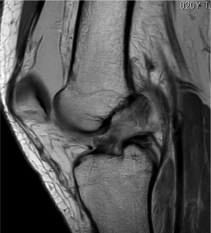 El ligamento cruzado anterior es una estructura que se encuentra en el interior de la articulación de la rodilla