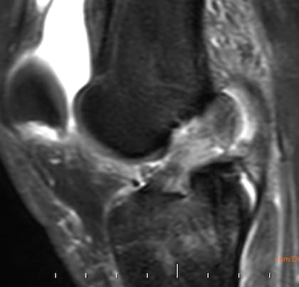 La rehabilitación juega un papel fundamental para retomar las actividades diarias