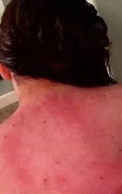 La mujer alérgica al agua toma analgésicos antes de bañarse