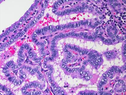 07/10/2019 Imagen al microscopio de células de cáncer. Se ha dicho que el uranio empobrecido generó problemas de salud como el cáncer y defectos de nacimiento en zonas donde se utilizaron en conflictos pasados PTC. SALUD WENDONG YU / BAYLOR COLLEGE OF MEDICINE.
